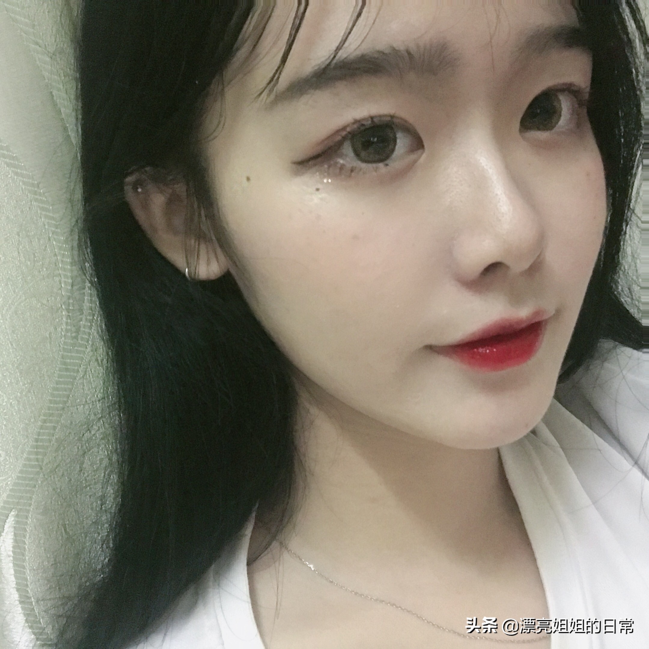 隆鼻改善蒜头鼻,蒜头鼻隆鼻一年后的真实感受