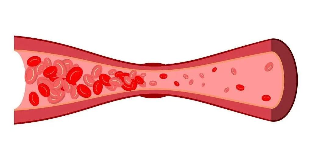 支架植入术和ptca的区别,支架植入和大支架有啥区别