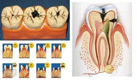 补牙为什么要抽掉牙神经,补牙把牙神经抽了有什么危害