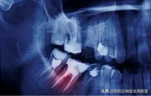 牙疼去看牙需要多久,牙疼的建议