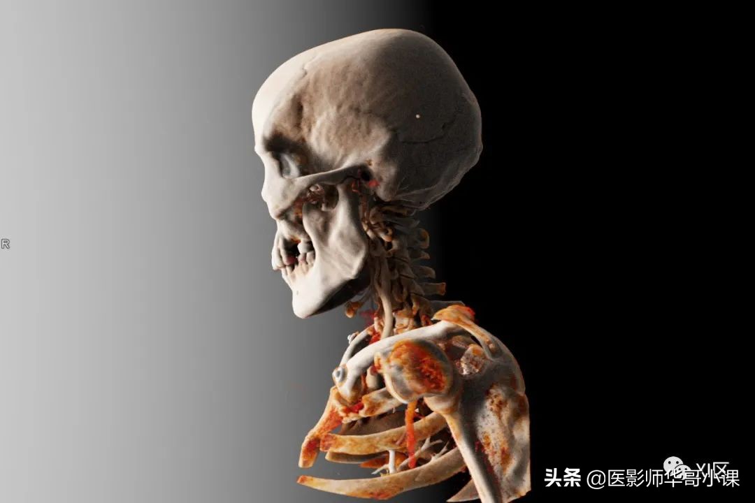 做完碘131检查后注意事项,碘造影剂的作用及使用