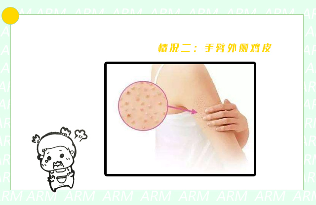 夏天胳膊粗怎么穿吊带才好,鸡皮肤非常严重怎么穿吊带