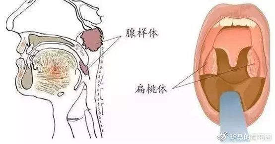 腺样体肥大对长大有什么影响,腺样体长大就萎缩害了多少孩子