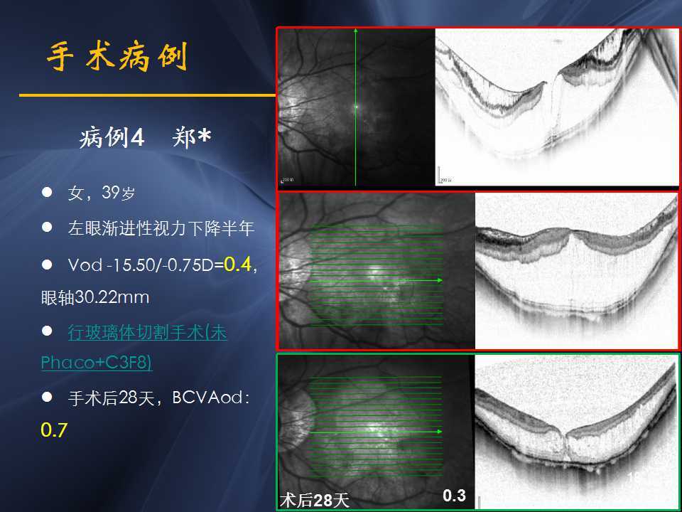 高度近视黄斑劈裂哪家医院好,高度近视黄斑劈裂中医治疗
