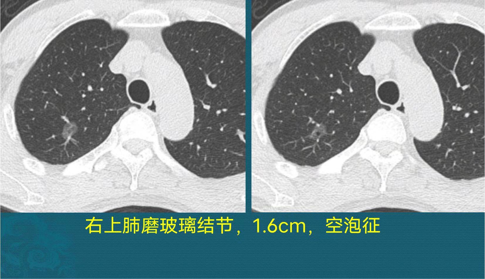 辟谣得了癌不治能活得更久,癌症能不能治医生说了大实话