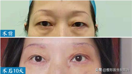 55岁如何做面部提升术好,40岁适合哪种面部提升手术