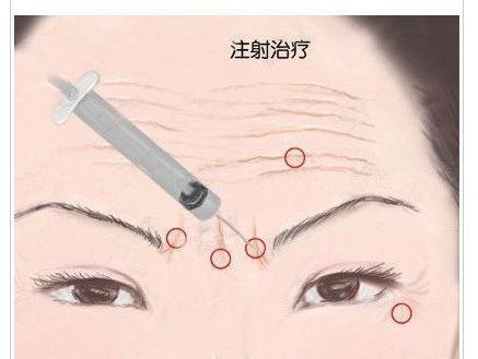 眼部除皱最有效的方法,眼部除皱最安全有效的方法