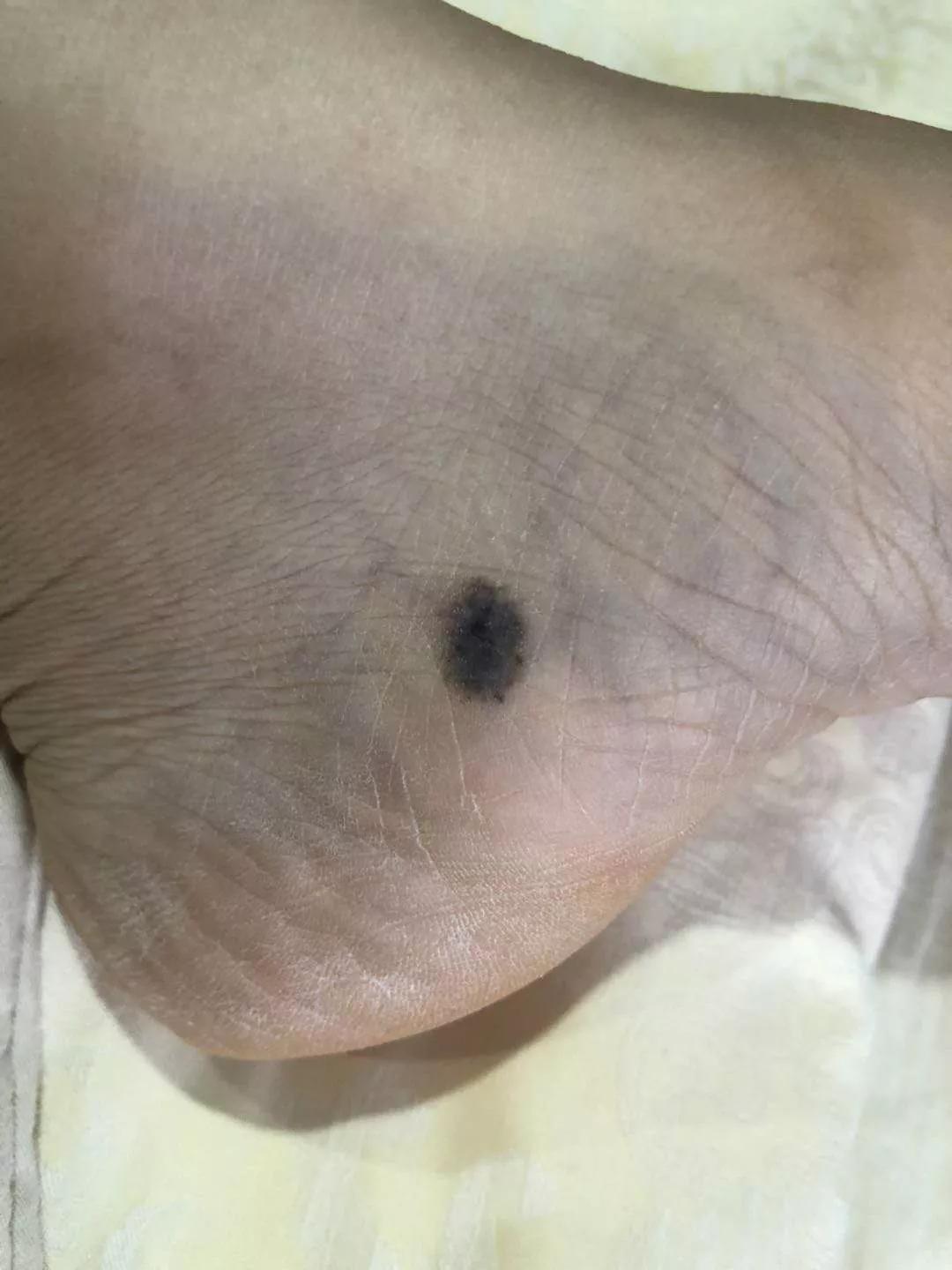 哪些黑痣容易恶变?需要切除吗?