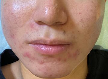 青春期月经逐渐规律的过程中长痘,青春期的痘痘来月经后会消失吗