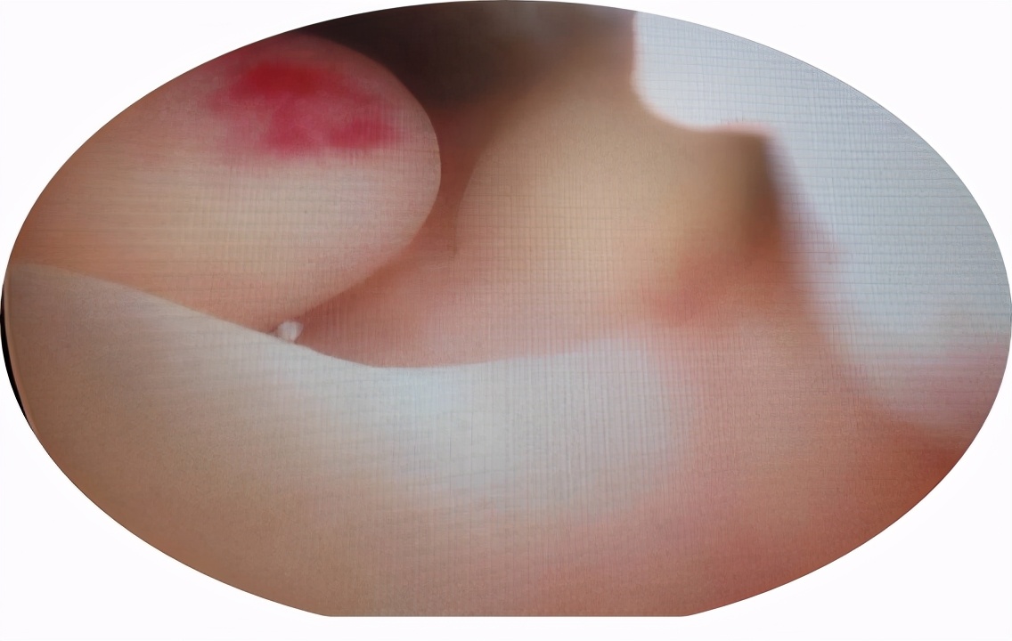 绝经后出血警惕四种疾病,绝经后出血当心卵巢癌