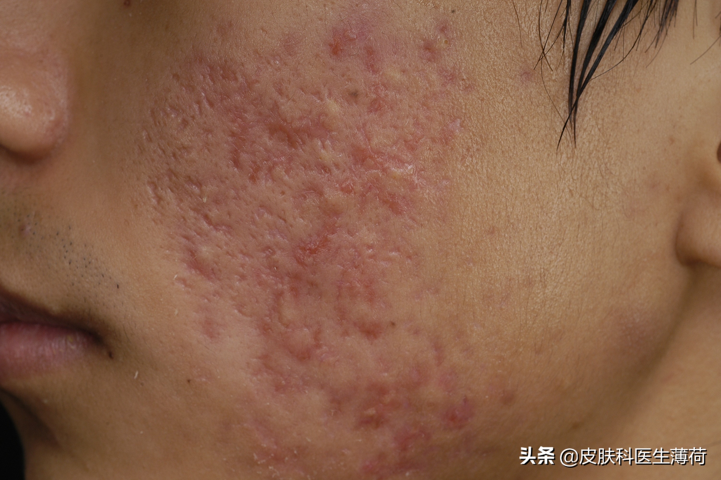 皮肤科医生怎么祛痘痘,皮肤科中医专家教你快速祛痘