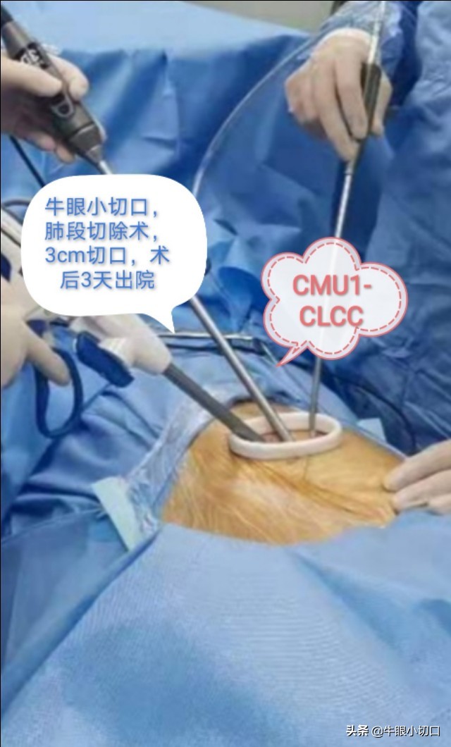 磨玻璃影肺腺癌切除最佳时机,肺磨玻璃结节ggo和ggn各表示什么