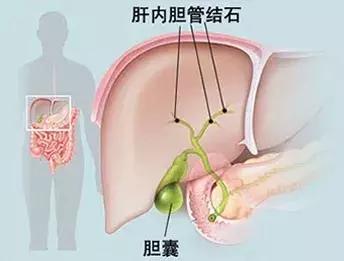 肝里面长结石怎么办,肝内胆管结石怎么治疗