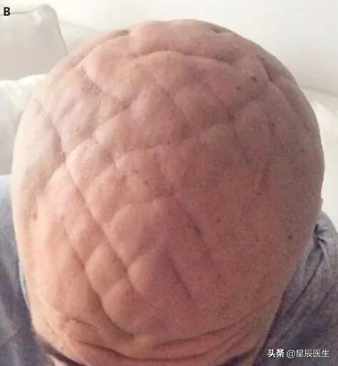 头皮上有蚊爬样感觉是怎么回事,头皮像蚊子叮过一样的包