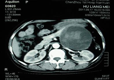 胰腺有哪些罕见病,胰腺上面最容易长的啥东西