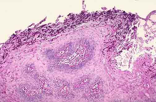 常见而隐匿的肺念珠菌你了解它吗？