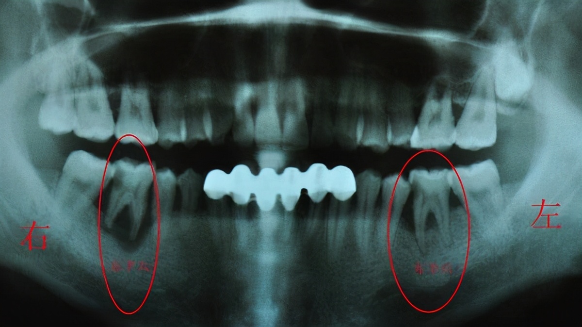 种植牙牙槽骨很薄怎么办,牙槽骨浅可以做种植牙吗
