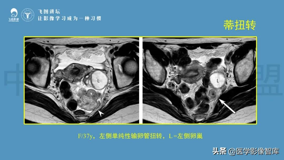 子宫解剖结构输卵管和卵巢位置,子宫附件ct影像学正常解剖表现