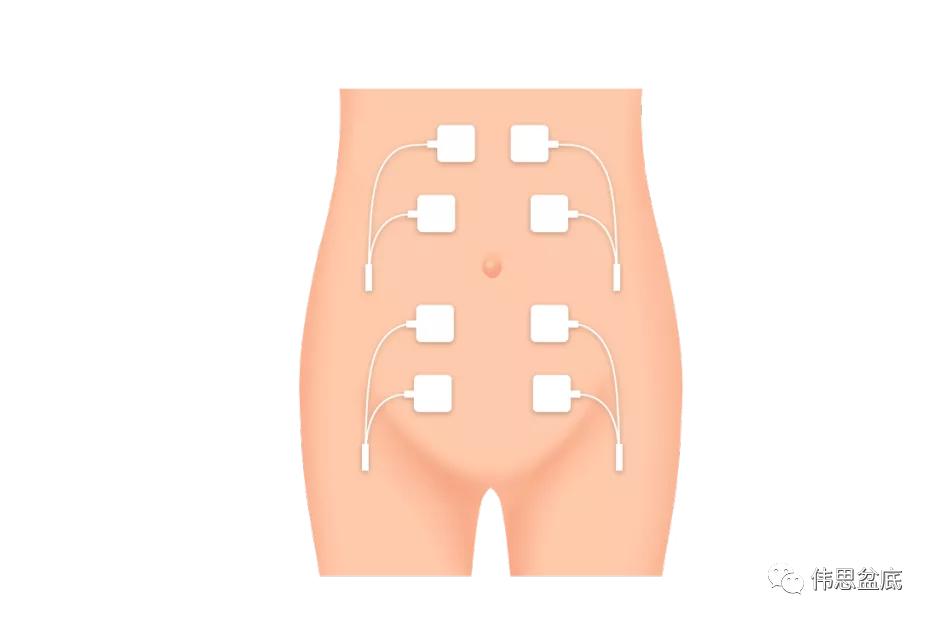 产后3年做腹直肌修复还有效果吗,产后3年做腹直肌修复还有用吗