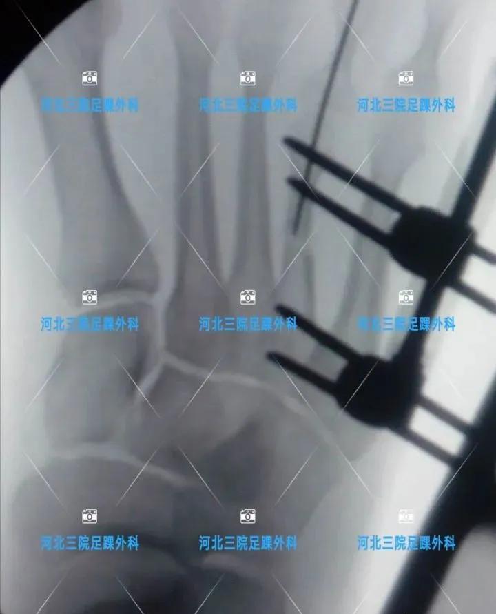 第四足趾短小怎么办,为什么第四脚趾短小