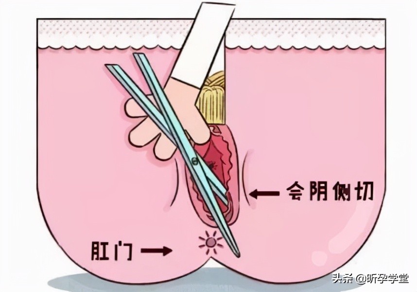 医生不建议侧切,医生不给我缝合伤口