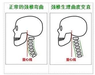 颈椎生理曲度变直会导致手臂疼吗,颈椎生理曲度变直会引起眩晕症吗