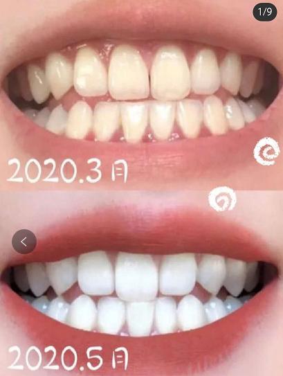 李佳琦牙齿怎么变白的,李佳琦怎么变白的