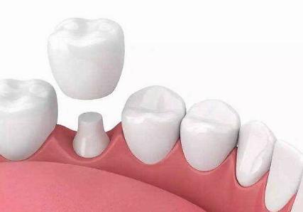 吴宣仪烤瓷牙怎么做,吴宣仪的整牙前