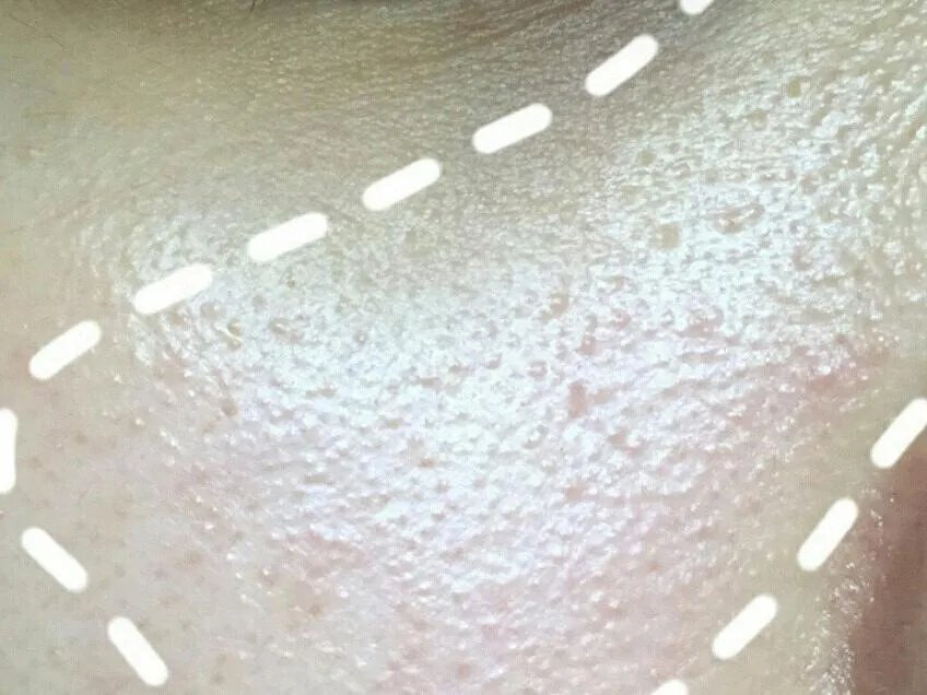 护肤界有名的难缠小妖精,现在搞定它