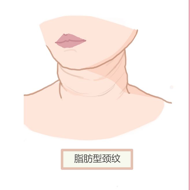 颈纹消除妙招医生推荐,有6条颈纹是什么原因