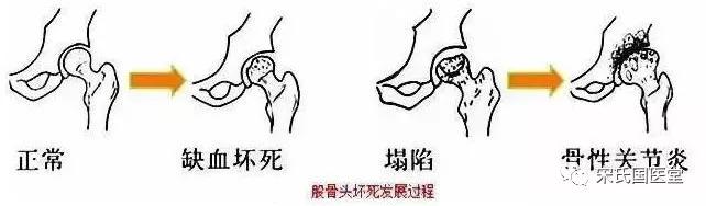 股骨头坏死漏诊图片,太康陈医生治疗股骨头坏死
