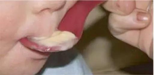 opt口肌评估,opt面部提拉