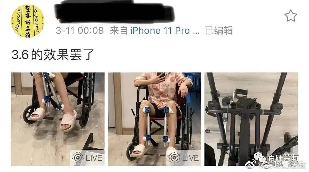 挑筋断骨切胃，那些为了美不要命的女人到底有多可怕