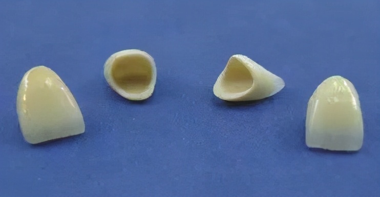 三甲医院全瓷牙保质期,全瓷牙有缝隙保质期是多久