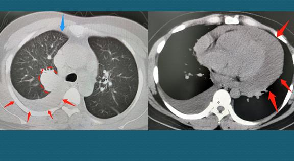 31岁肺癌自愈案例,三十岁肺癌晚期