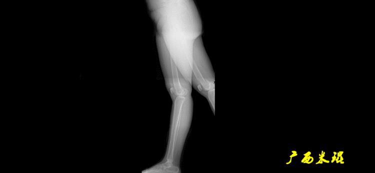 广西骨科医生米琨最新信息,米琨广西骨科什么水平