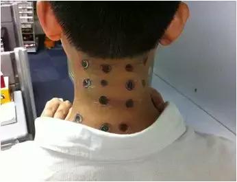 颈椎病三招搞定,几招搞定颈椎病