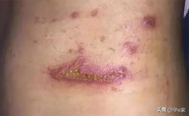 身上出现许多小黑痣,身上出现凸起黑痣一定要重视
