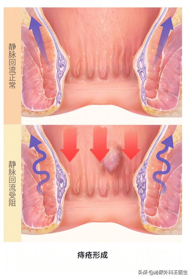 肛门摸到了小肉球,是痔疮还是尖锐湿疣?医生来教你区分