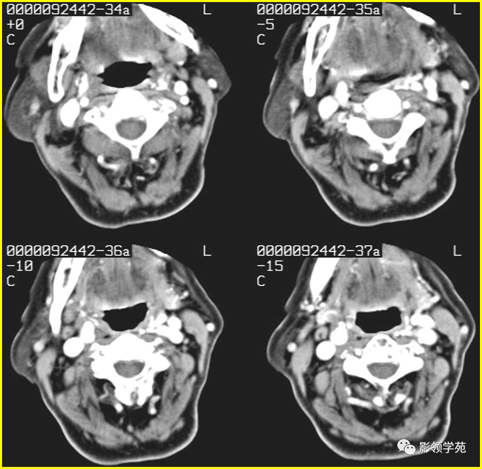 腮腺疾病影像学诊断,腮腺肿块影像诊断