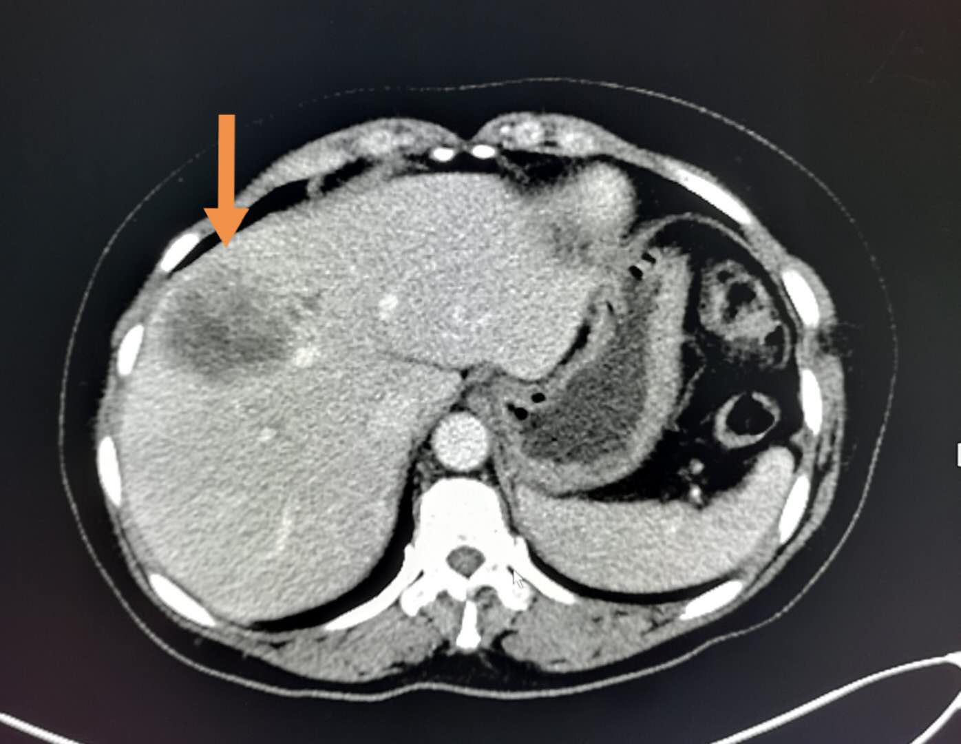 5个小故事：肺结核、脑梗死、车祸，这些意外发现的肺癌都能治