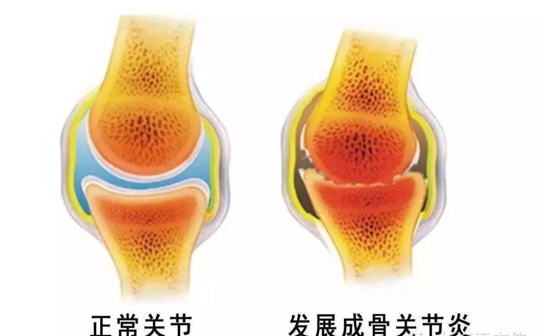 站着腿打软是什么原因,走着腿突然软一下怎么回事