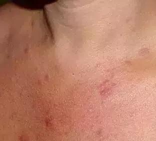 闭口粉刺痘痘黑头白头的区别,开口粉刺和闭口怎么区分