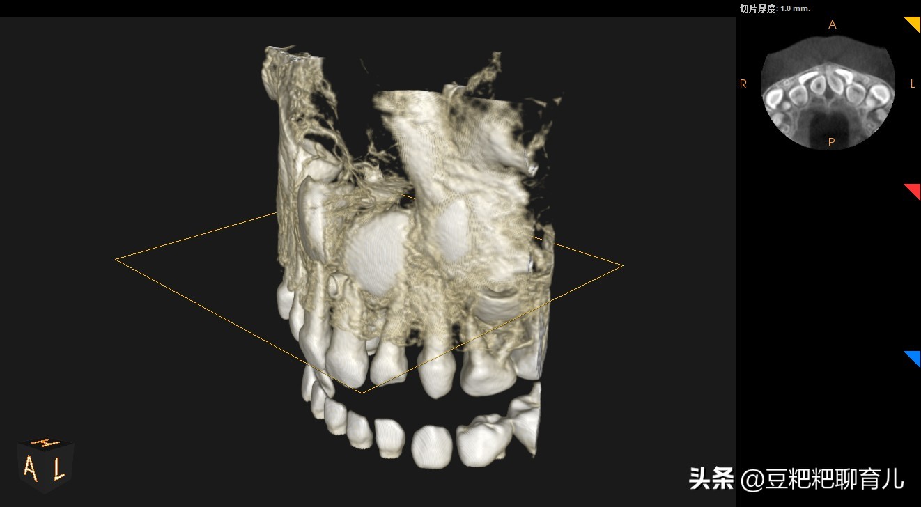 孩子的牙齿疾病之一，越来越多的孩子有“多生牙”，你了解它吗？
