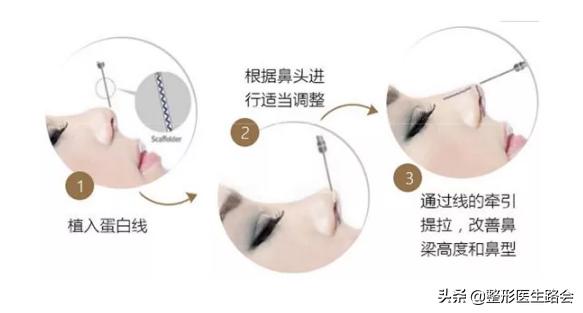 线雕隆鼻做出来不平,线雕隆鼻为什么没什么改变