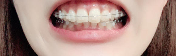 牙套日记一年级,牙套日记在线观看