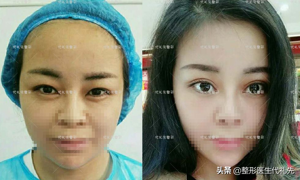 眼睑松弛下垂最佳解决方法,上眼皮松弛显老视频