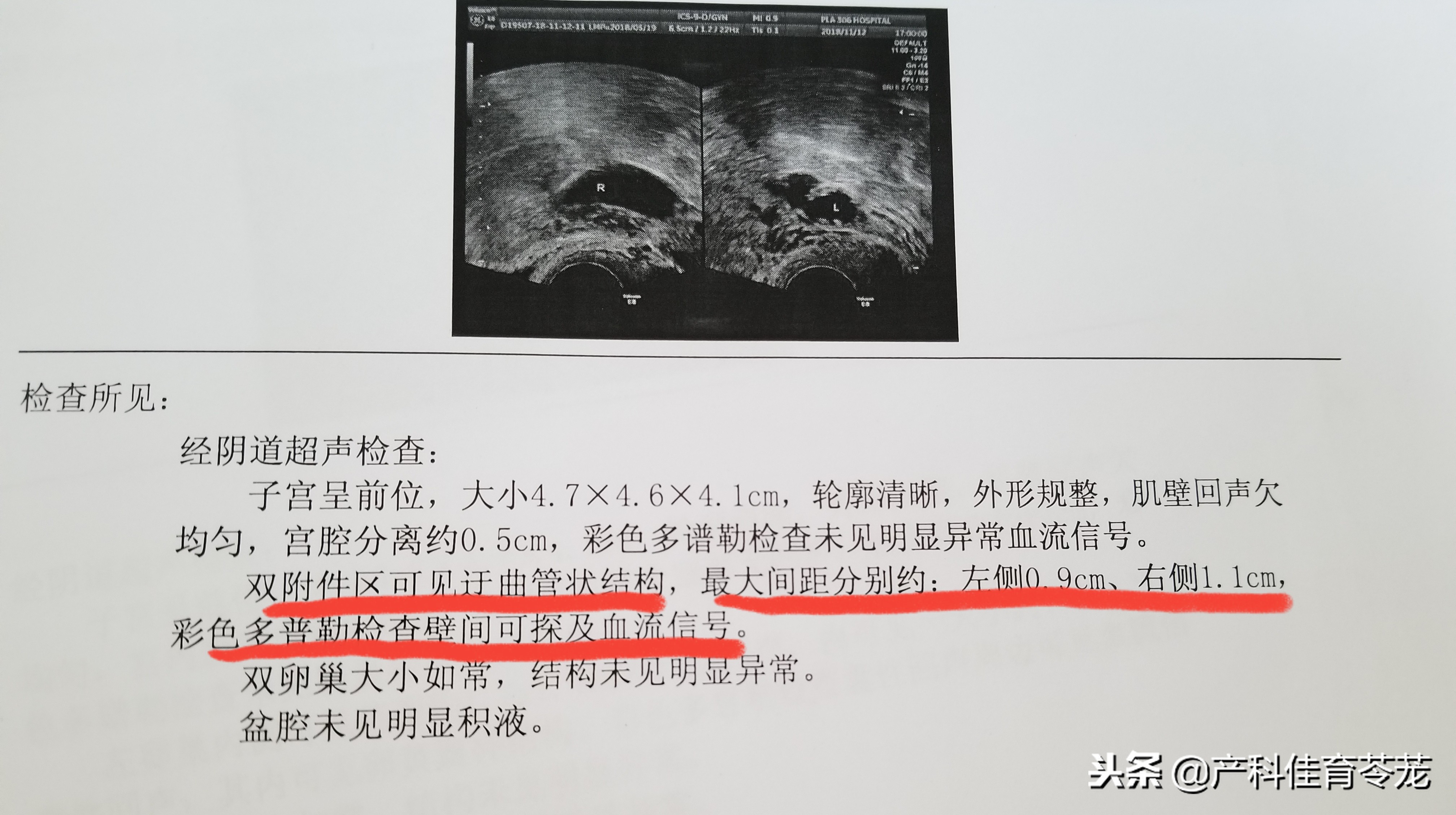 胸腔积液b超显示图,老年妇科b超检查下来有少量积液
