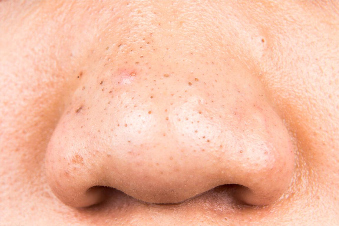 鼻子黑头白头怎么去除最有效,鼻子黑头白头怎么去除