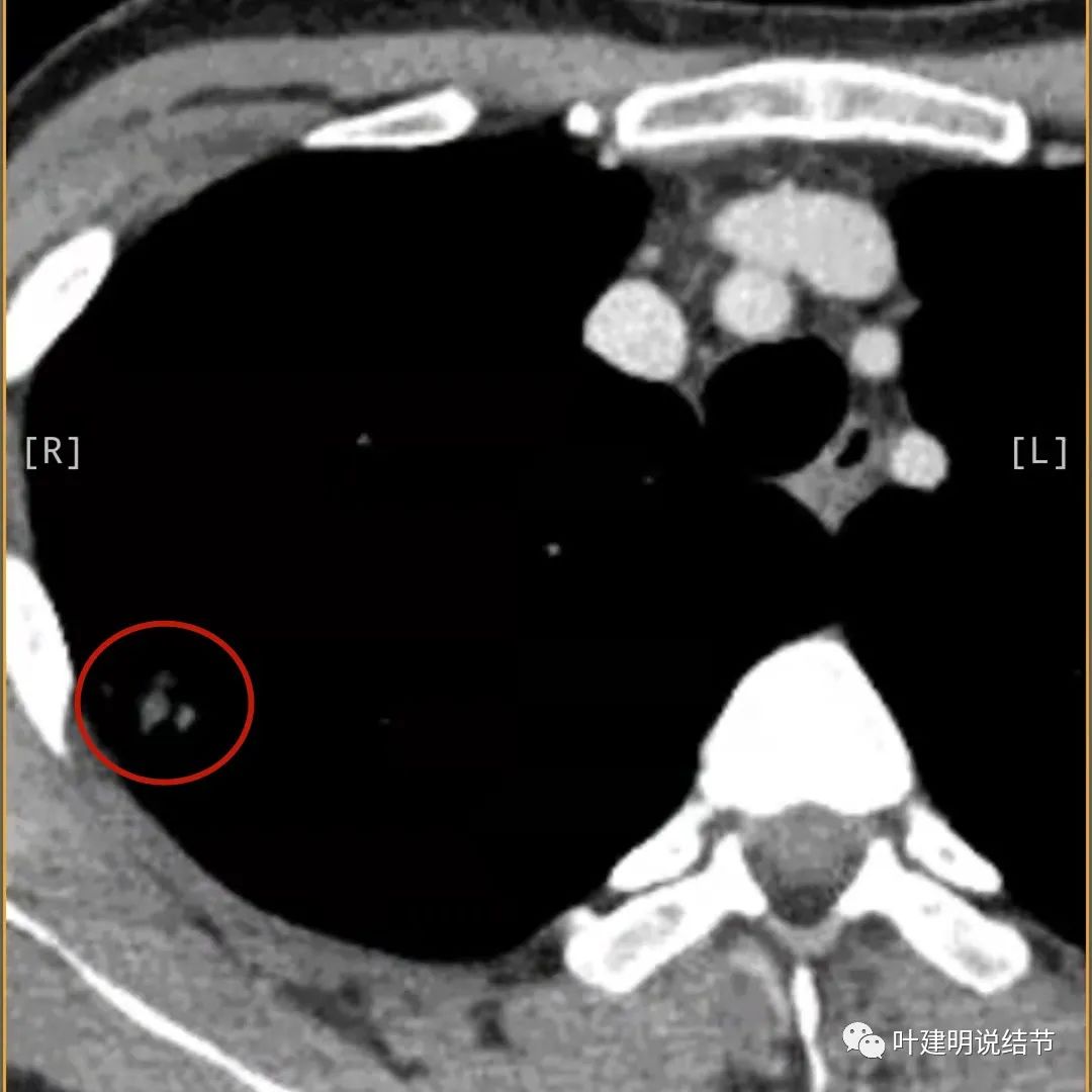 临床诊断孤立性肺结节,空洞型结节一般是什么性质